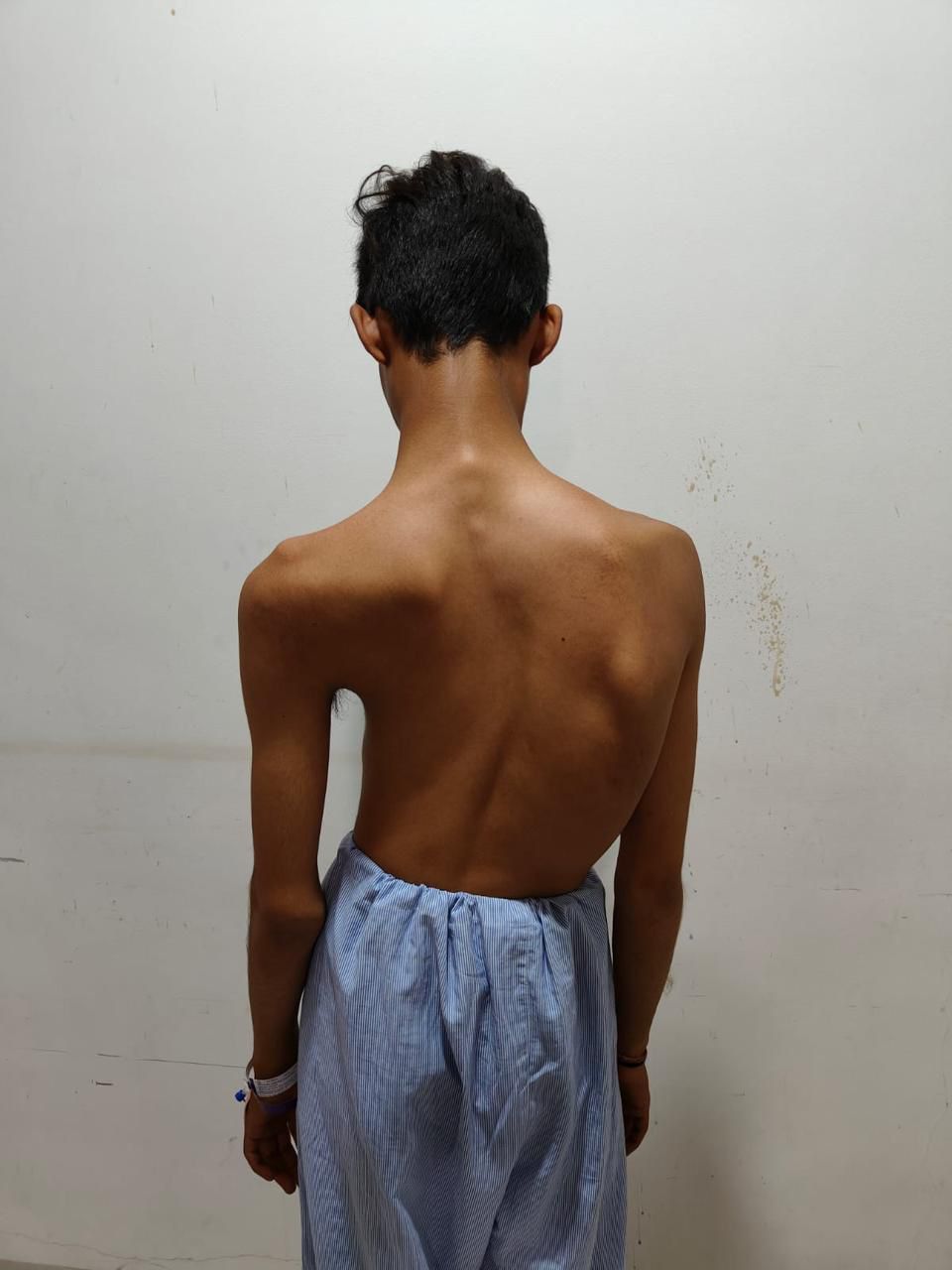 Illustration showing scoliosis in teenagers