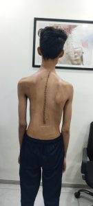 Back posture comparison of normal spine and scoliosis in teen